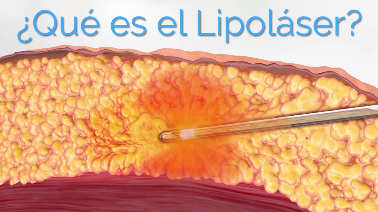 Liposuccion Laser ¡Guía paso a paso! 【2020】